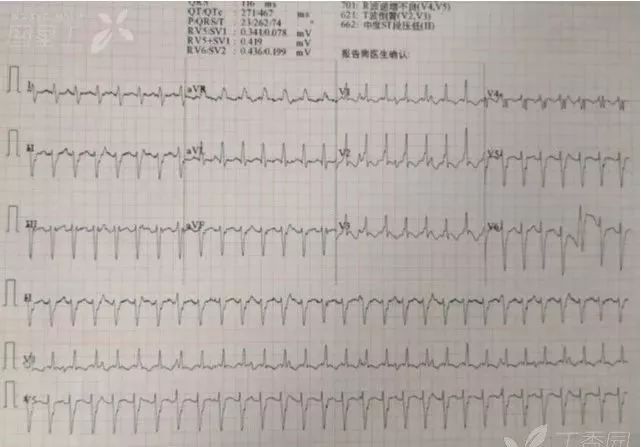 病例学习以咳嗽腹痛起病的暴发心肌炎