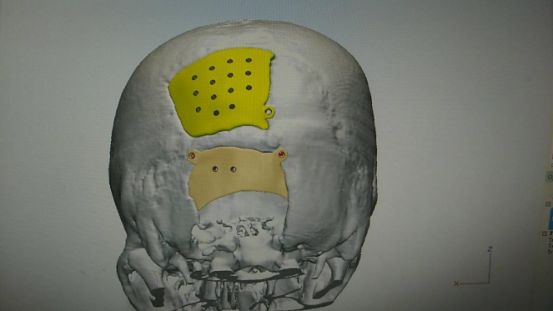 围观小伙儿颅骨缺损3d打印技术补全