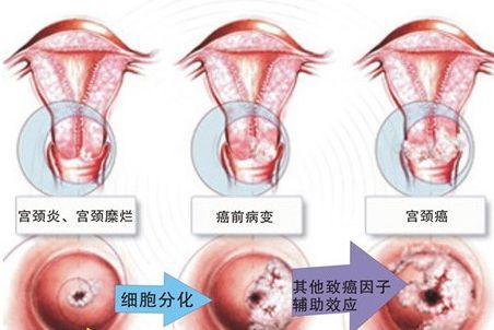 警惕宫颈炎,可能是造成女性不孕的元凶