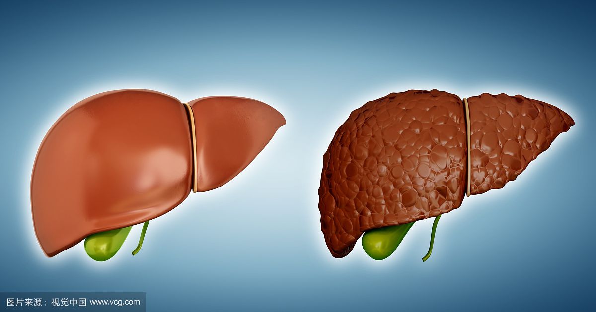 肝癌是癌症之王,肝脏不好全因这五个坏习惯!