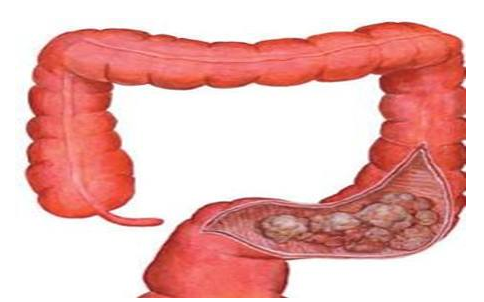 肠癌转移与扩散特点,肠癌复发特点