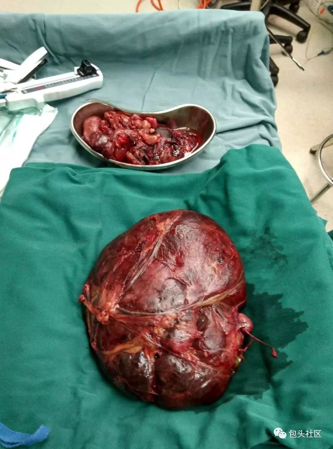 包头一男子腹部隆起如身怀六甲!腹腔取出12斤重肿瘤
