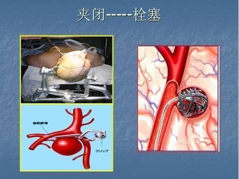 颅内动脉瘤介入治疗与开颅夹闭怎么选择