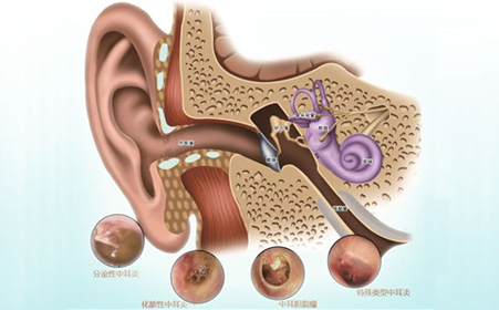 会引起中耳炎的原因有哪些?