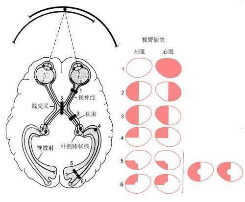 贺晓生教授:视野缺损视物倾斜当心脑瘤!