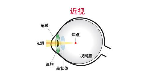 近视也分真假你分得清吗