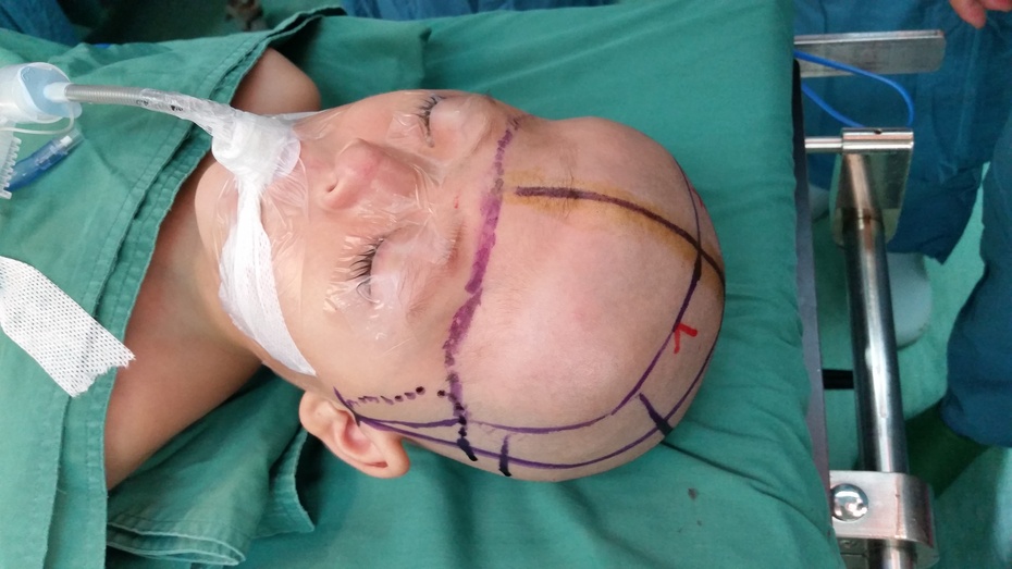 贺晓生教授:儿童头颅畸形的手术治疗