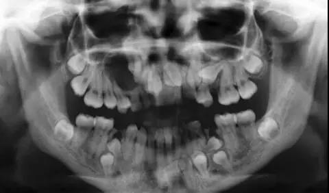 健康 正文 真相:在牙齿诊断治疗的过程中,牙片(牙科x光)有助于牙医