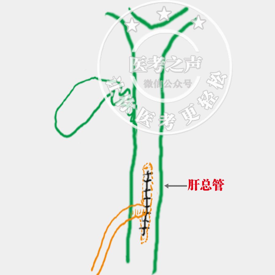 图文结合,瞬间秒懂,轻松搞定肝外胆管结石