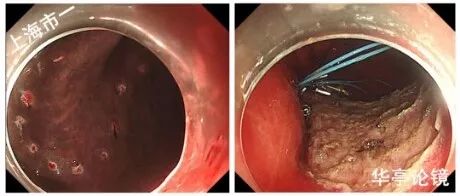 4个精彩病例,带你了解早期胃癌(有图有真相)