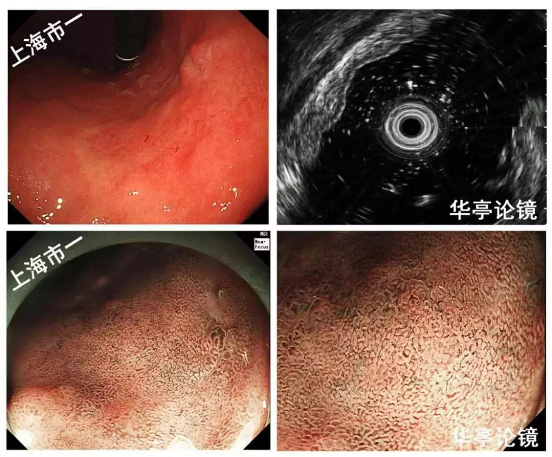 4个精彩病例,带你了解早期胃癌(有图有真相)