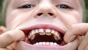 6岁儿童双排牙怎么办
