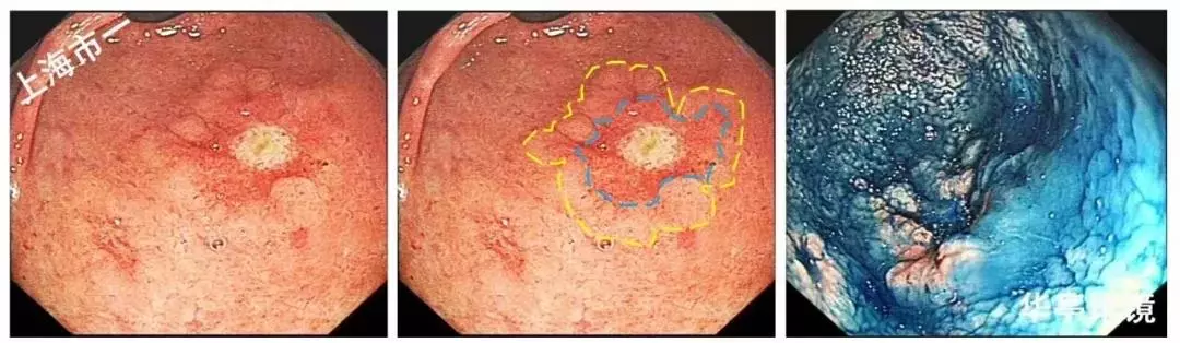 特检胃镜:白光内镜-靛胭脂染色-超声内镜-me-nbi.