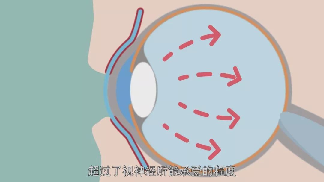 不知不觉就瞎了?这几类人群都很容易患上青光眼!