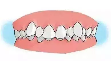"发现即矫正"谈谈12岁前必须处理的20种儿童牙颌畸形!