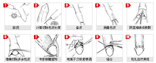 正经科普!请保住男孩"小麻雀"的包皮