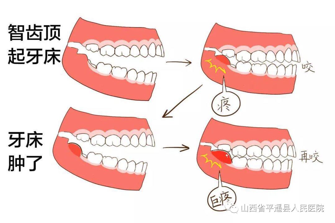 那么问题来了,放飞自我生长的智齿,会给主人带来什么牙疾呢?