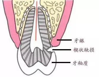 因此称为 『楔状缺损』.