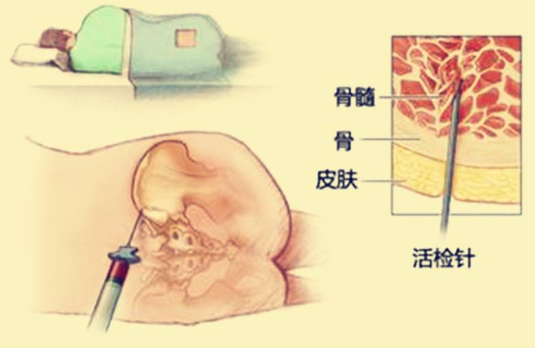 麦默通手术多久穿内衣_美女只穿内衣