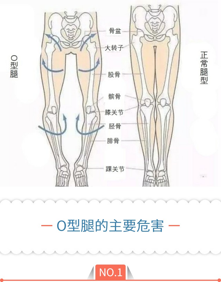o型腿由于肌肉分布不匀称,显得大小腿都很弯,这样腿失去了笔直曲线