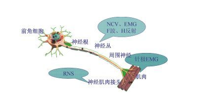 哪些是运动神经元的临床症状