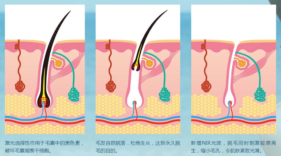 飞顿冰点脱毛技术原理是什么?