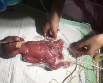 山西最小早产儿康复!这个"手掌婴儿"出生时仅790克!胎龄只有6个月.