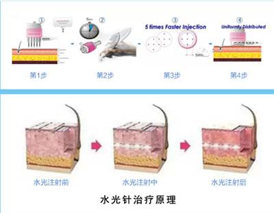 实际上就是用水光针仪器 一次性针头,均衡的把营养成分注入皮肤