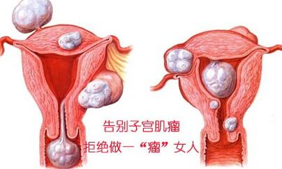 了解子宫肌瘤,呵护女性健康