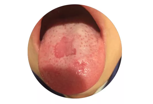 正常的舌苔是人体水谷精气在舌面上的表现,而水谷精气的形成又依赖于