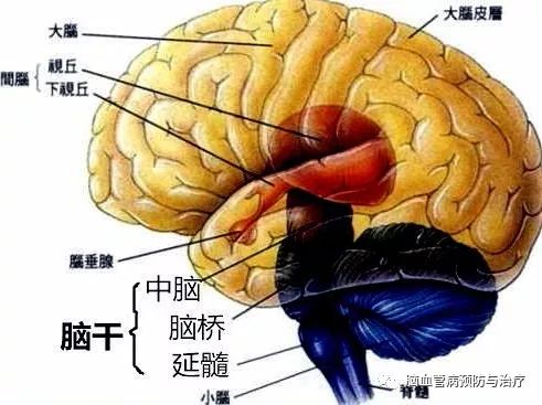 脑干出血非死即残,一线生机在哪里?