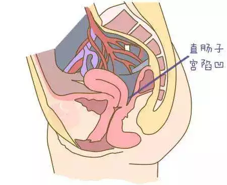 其异位处多在直肠陷凹处,形成坚实的结节或包块.关爱女性健康,体