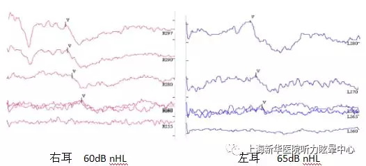 脑干听觉诱发电位(abr)检查: 对于无法完成行为测听的患儿,通过早期