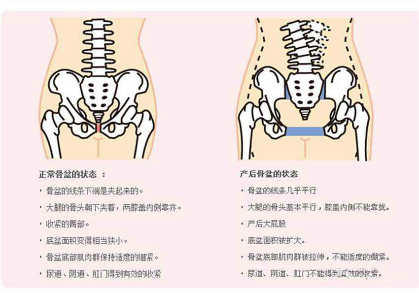 关于盆骨变形的那些事儿女人一定要看