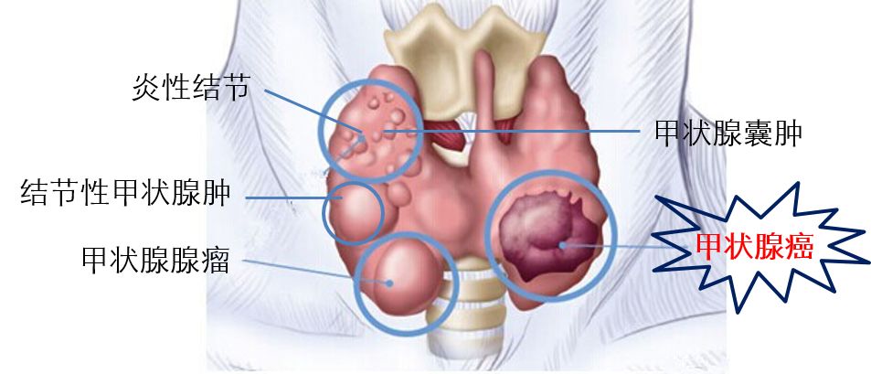 前4个为常见的良性病变,在未明确其性质以前统称为甲状腺结节