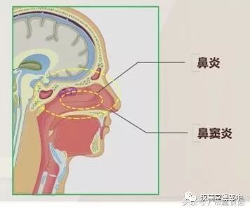 第一步,鼻炎和非鼻炎相鉴别;通过前鼻镜的检查,判断是鼻炎还是其他