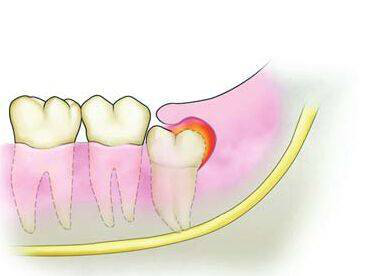什么是智齿?_搜狐健康_搜狐网