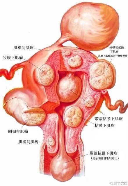子宫肌瘤45孕期阑尾位置变化44孕期改变43异位妊娠,以输卵管为最高发