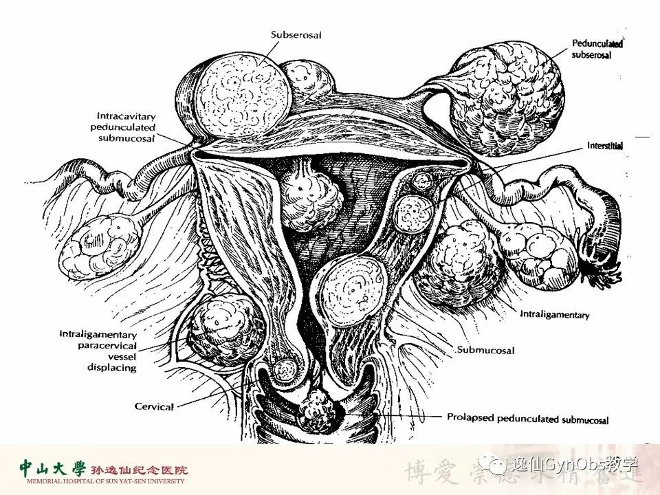 子宫肌瘤中山大学医学院八年制妇产科大课