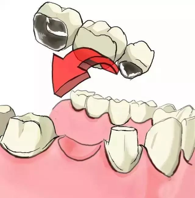 图解种植牙和镶牙不同之处?一看便知