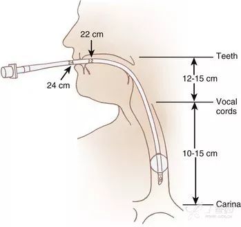 你和主任的气管插管就差这9步