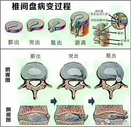 腰疼怎么办啊