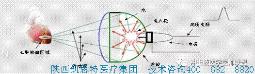 体外冲击波如何让心肌血管再生?