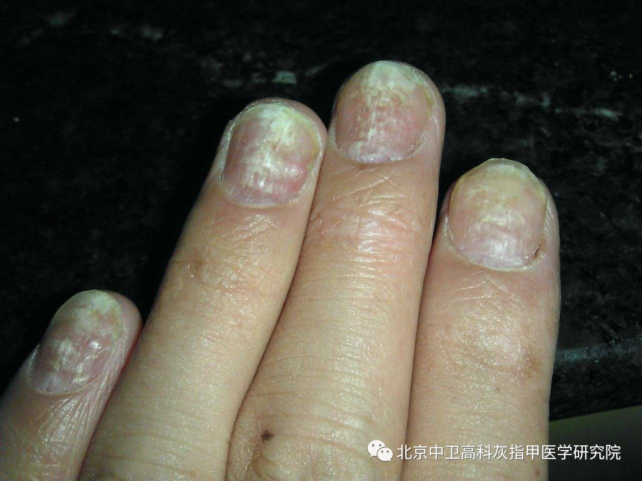 不同类型的灰指甲都有哪些症状