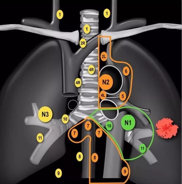 一文巧记肺癌tnm分期及预后分组,再也不怕
