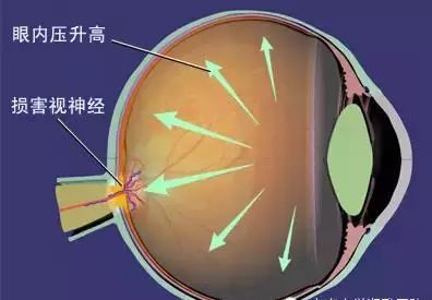 青光眼喜欢找谁? 关灯玩手机会失明?