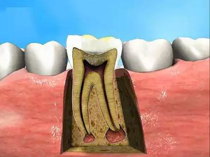 根尖周炎牙髓炎没有及时治疗向下发展导致牙根尖周围组织发炎,导致