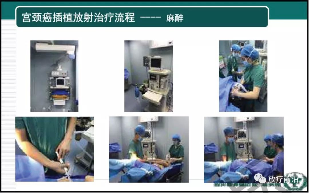 大咖分享 | 四川省肿瘤医院谭燕:宫颈癌放疗经验