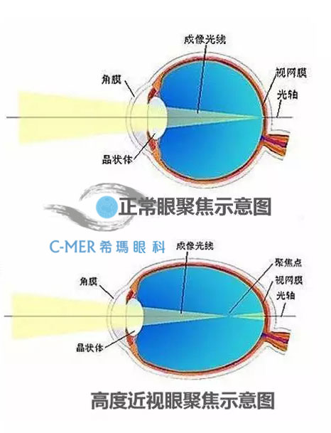 高度近视引发的危害多保护眼睛刻不容缓