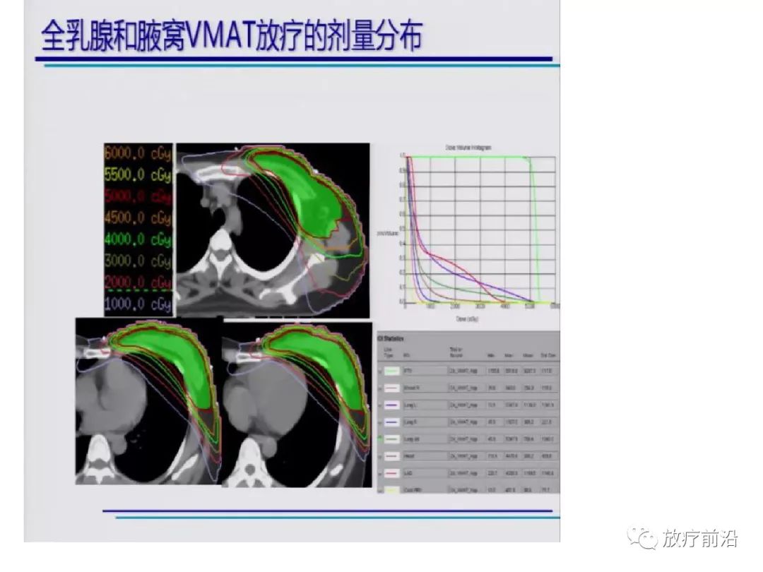 大咖课 | 东肿王淑莲:乳腺癌术后放疗靶区勾画